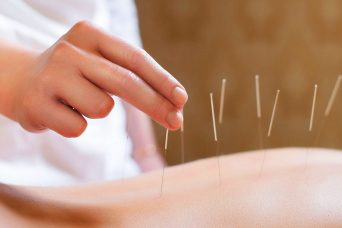 Acupuncture - MedWorld Clinic