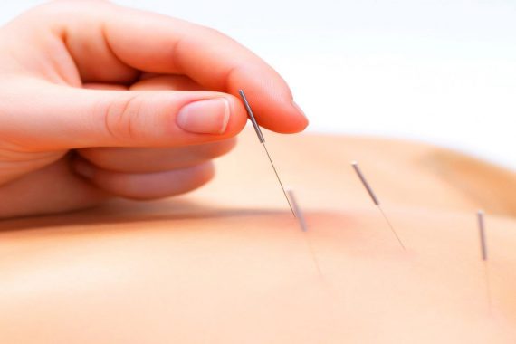 Acupuncture