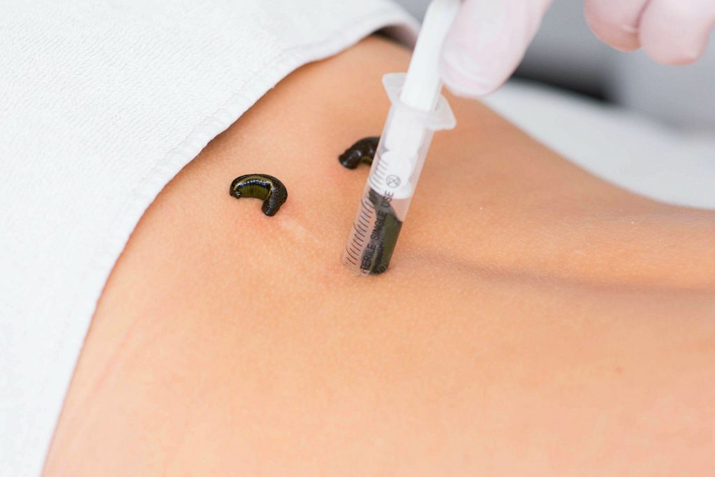 Leech Therapy - Medworld Clinic