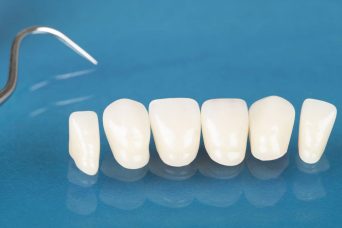 Veneers Keramikbeschichtung