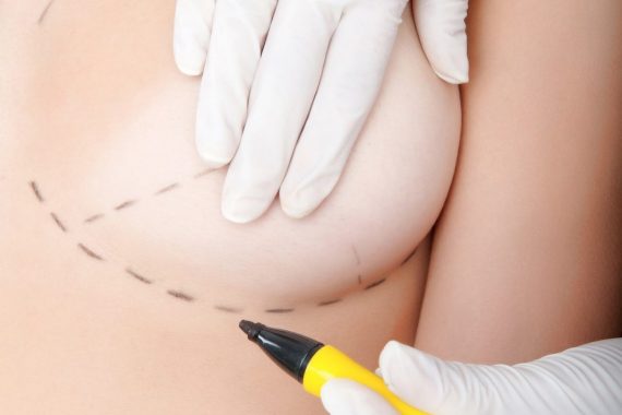 Breast Augmentation Recovery MedWorld Clinic Rixos Antalya