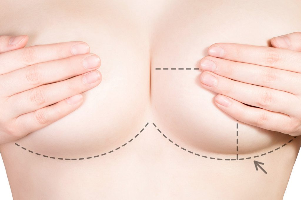 Breast Reduction recovery process