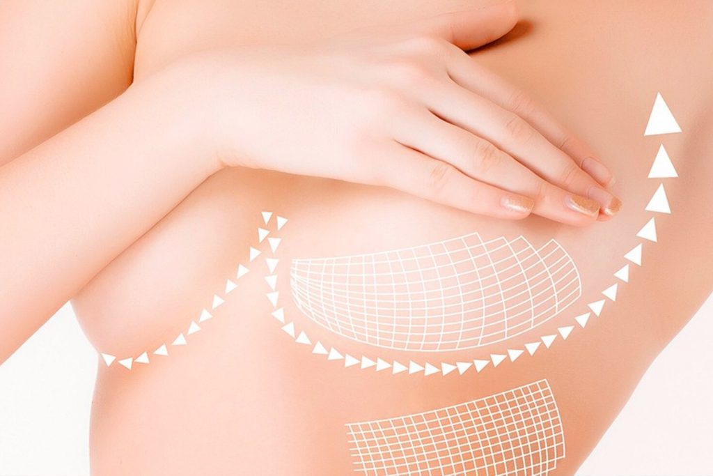 mastopexy (boob lift) surgery in Turkey