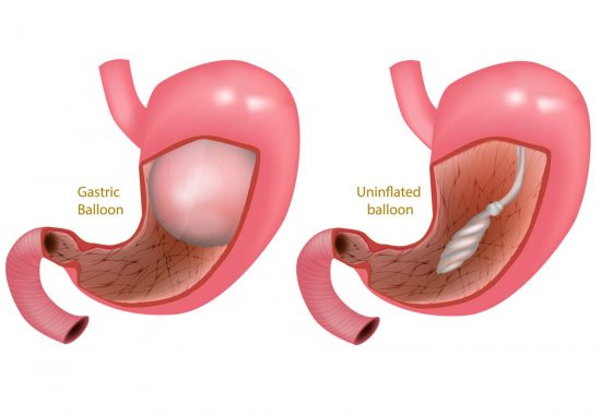 Gastric Balloon - Medworld Obesity Clinic