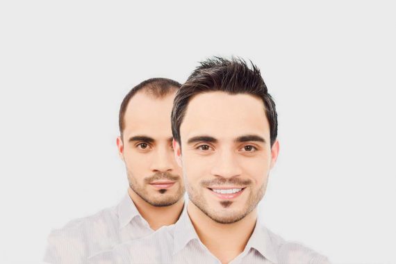 Hair Health Transplant