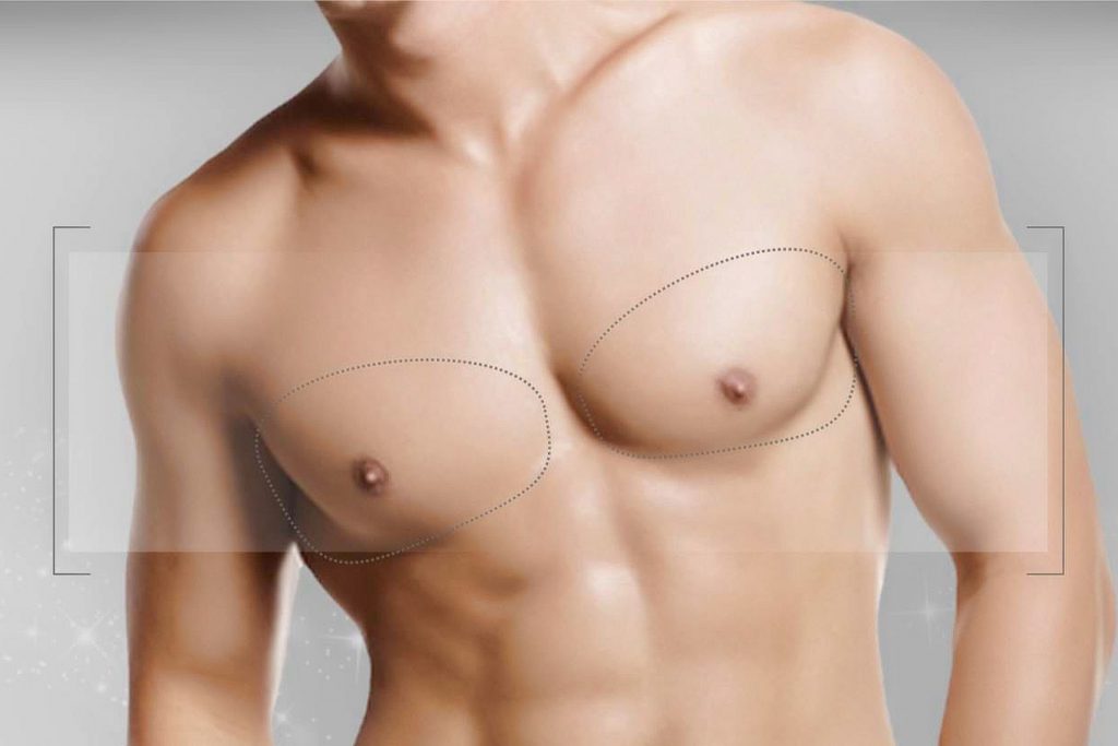 Male Mammoplasty Breast Reduction Gynecomastia Surgery in Turkey