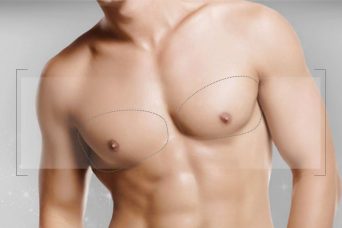 جراحة تجميل الذكور – التثدي