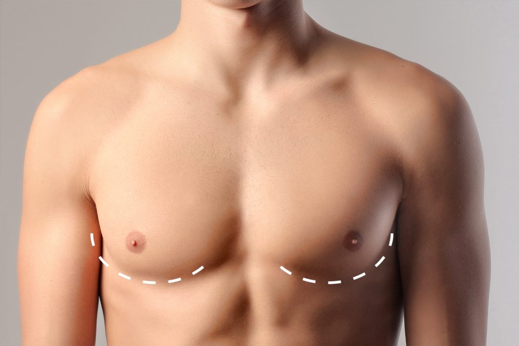 male mammoplasty (male breast reduction) gynecomastia surgery Turkey