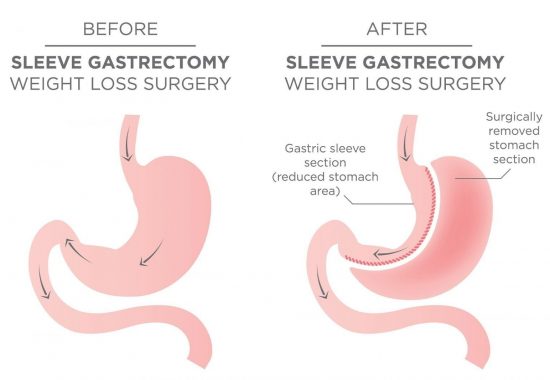 Magen-Sleeve Chirurgie