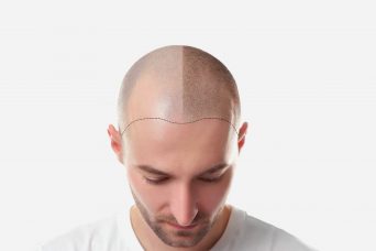 FUE method Hair Transplant