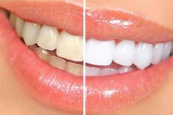 Laser Teeth Whitening