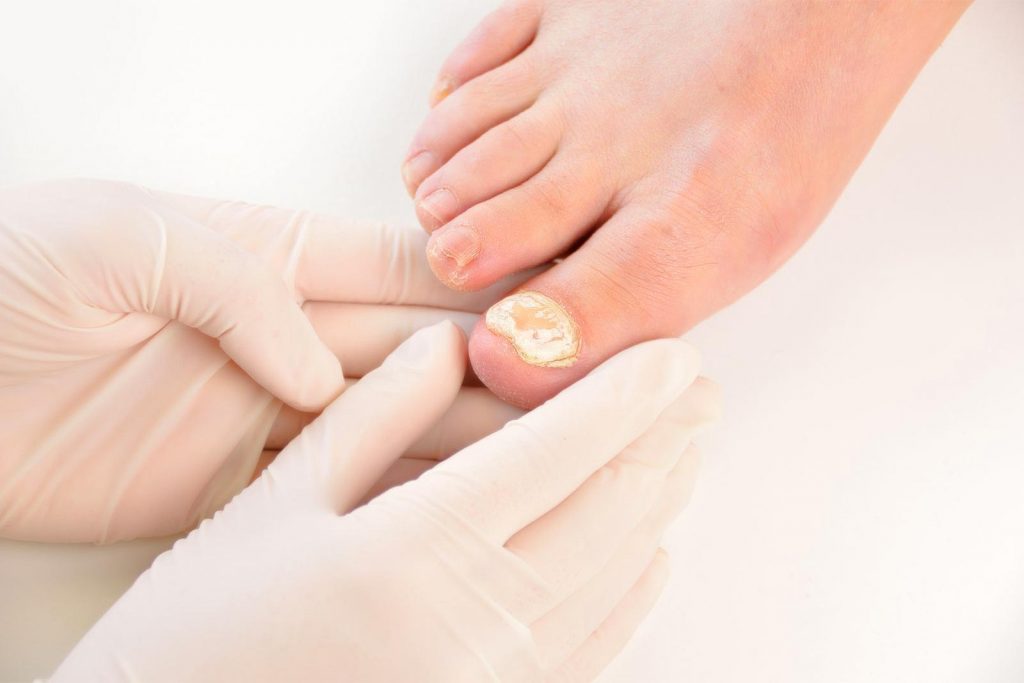 hogy a köröm gomba van kialakítva a lábak nail gombák száj- vakolatok a kezelés
