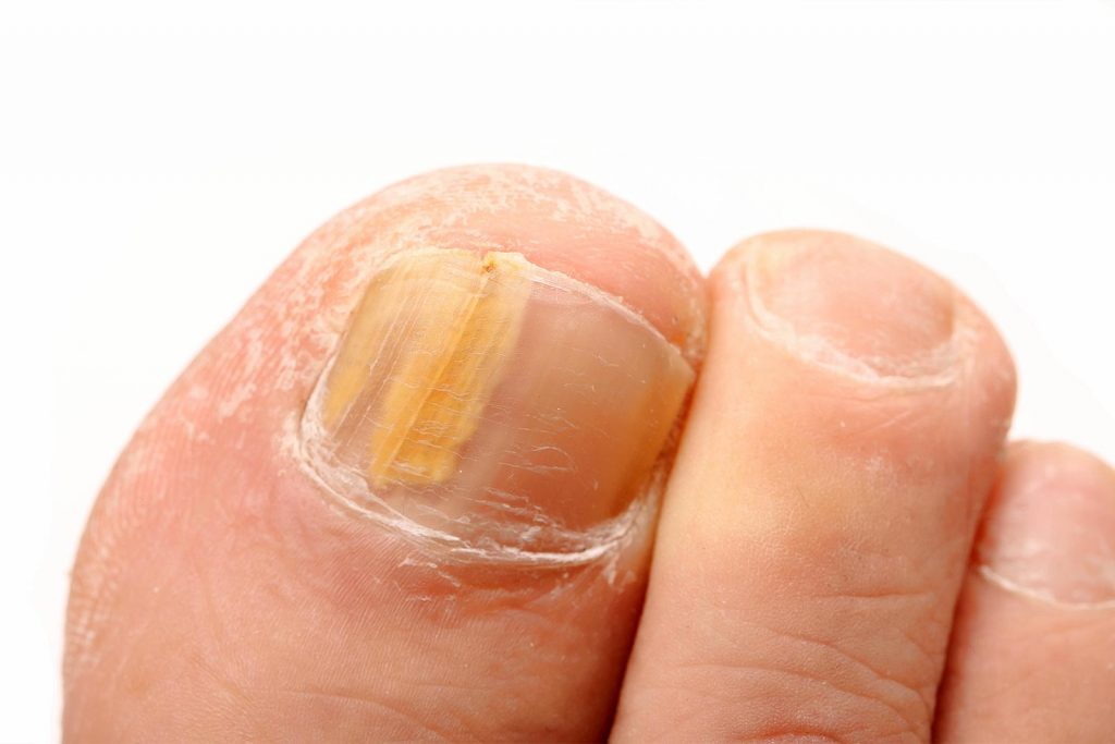 Nail Fungus - Medworld Clinic