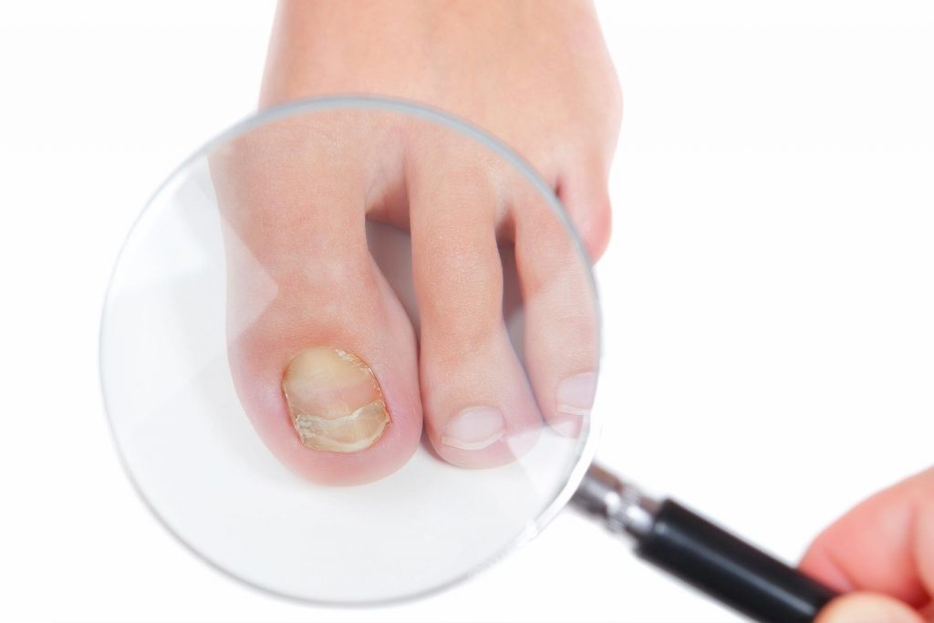 Nail Fungus - Medworld Clinic