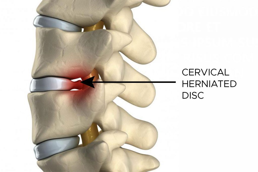 Cervical Herniated Disc Treatment MedWorld Clinic Antalya