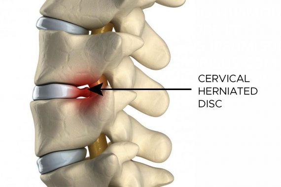 Cervical Disc Hernia