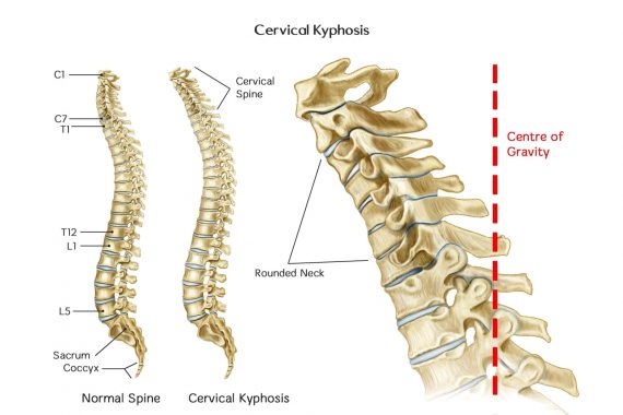 Cervical kyphosis treatment