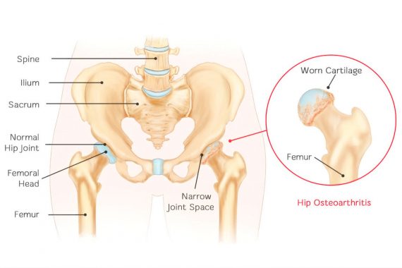 Hip Osteoarthritis