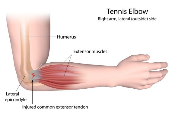 Laterale Epikondylitis (Ellenbogen des Tennisspielers)