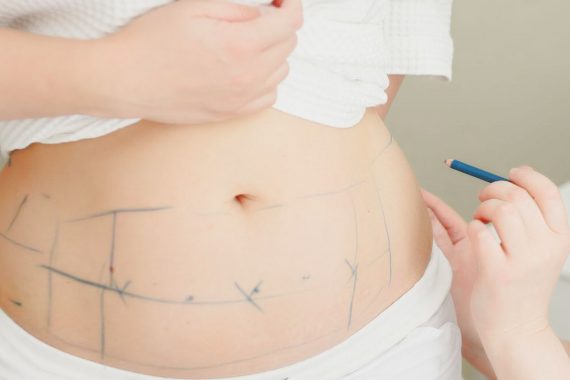 Liposuction Treatment - MedWorld Clinic