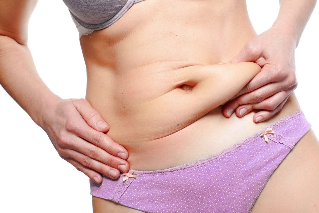 Tummy tuck with liposuction of the mons pubis, and a pubic lift 