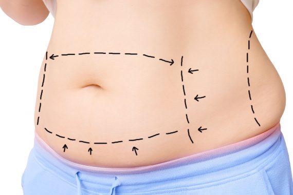 abdominoplasty (tummy tuck surgery)