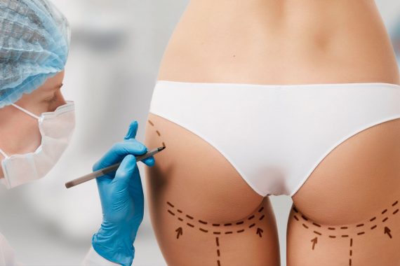 Butt Lifts: An Overview  Athēnix Advanced Plastic Surgery & Aesthetic  Centers