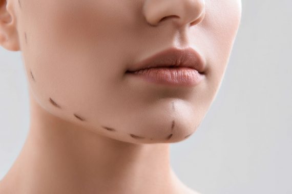 Chin Filler - Medworld Esthetic Clinic