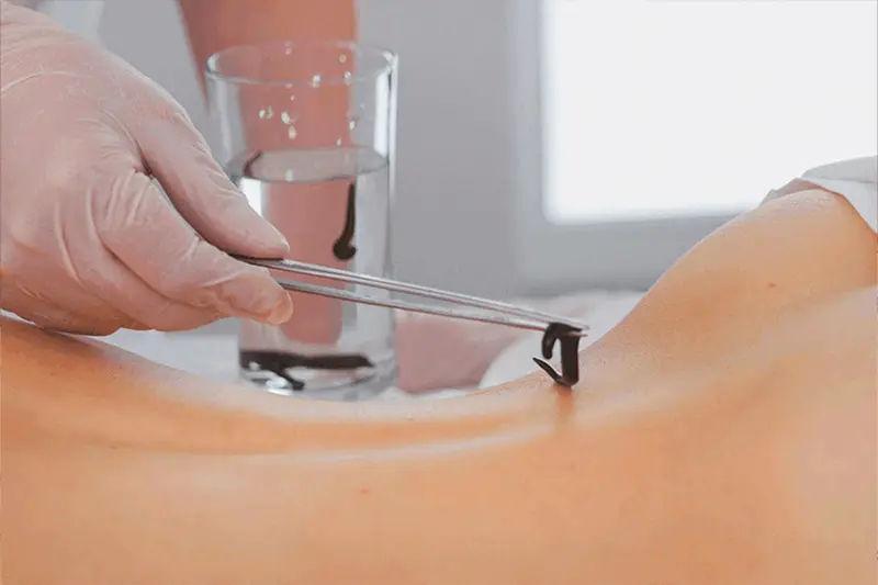 Leech Therapy
