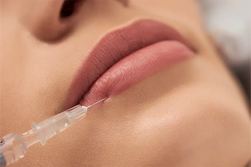 Lip Filler