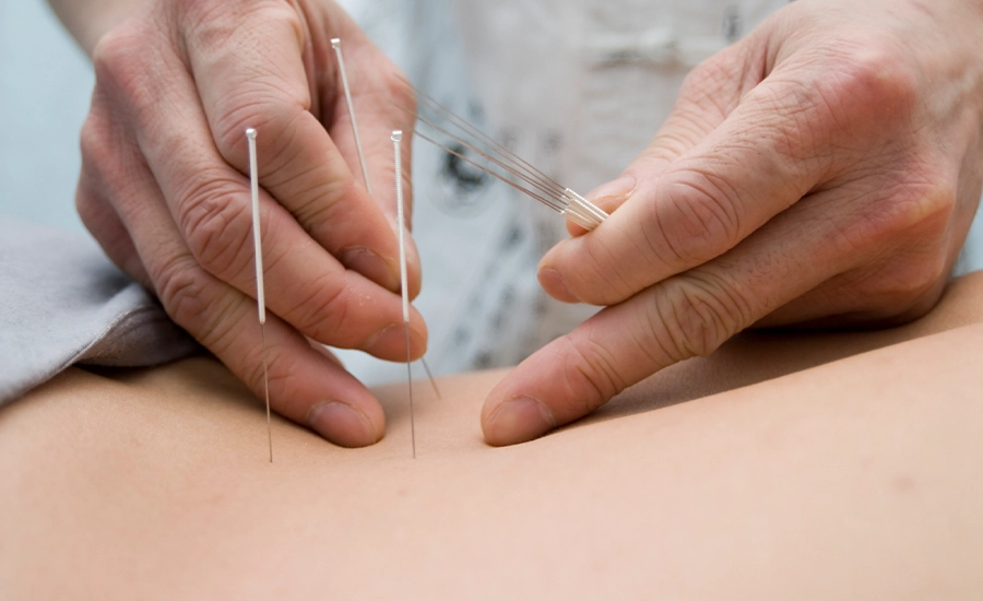 Acupuncture (traditional Chinese), Acupuncture, Acupuncture in Antalya