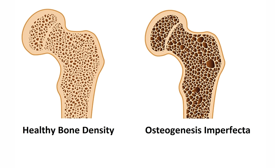 Bone and mineral health, Bone and mineral health assessment, Bone and mineral health in antalya