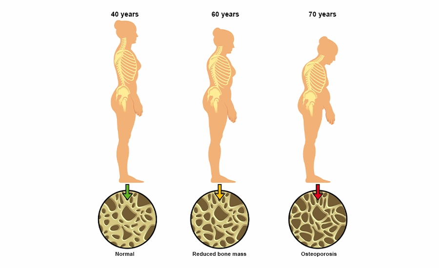 Bone and mineral health, Bone and mineral health assessment, Bone and mineral health in antalya