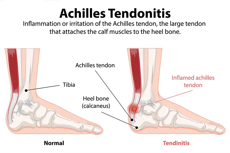 Achilles Tendinitis Treatment