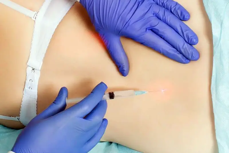 Caudal Epidural Injection