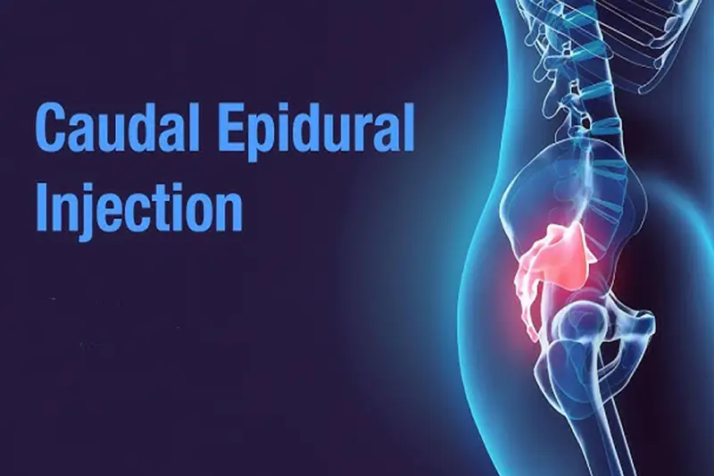 Caudal Epidural Injection