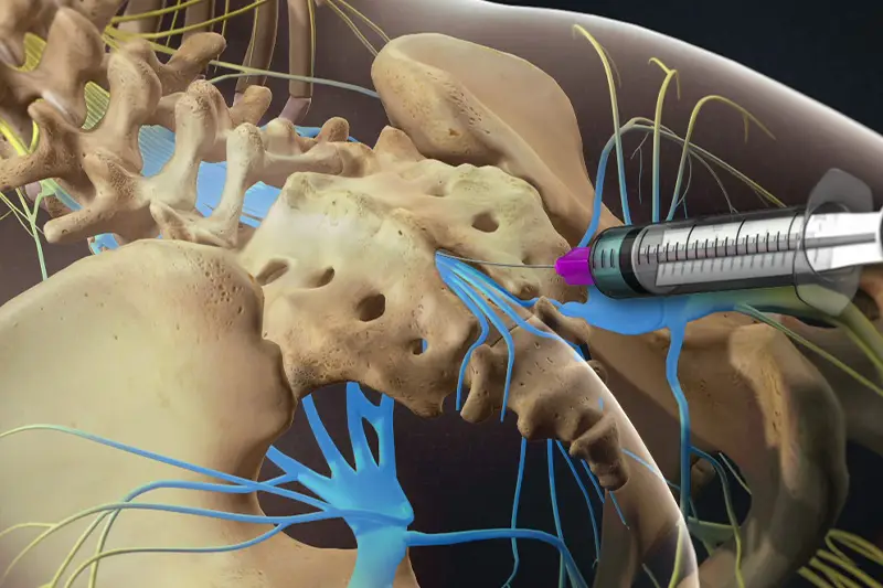 Caudal Epidural Injection