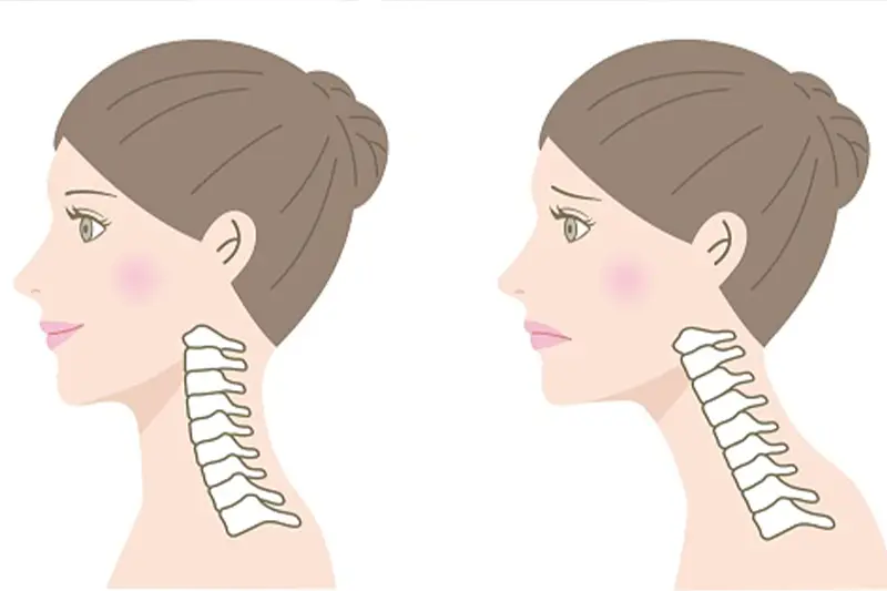 Cervical Lordosis Loss (Neck Straightening)
