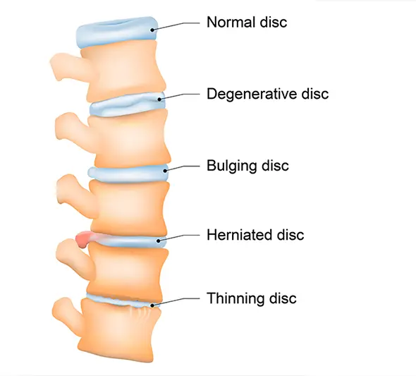 Degenerative Disc Disease Treatment
