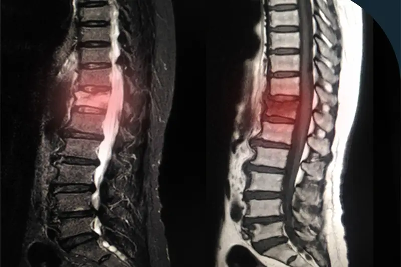 Degenerative Disc Disease Treatment