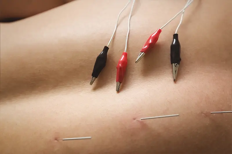 Dry Needling