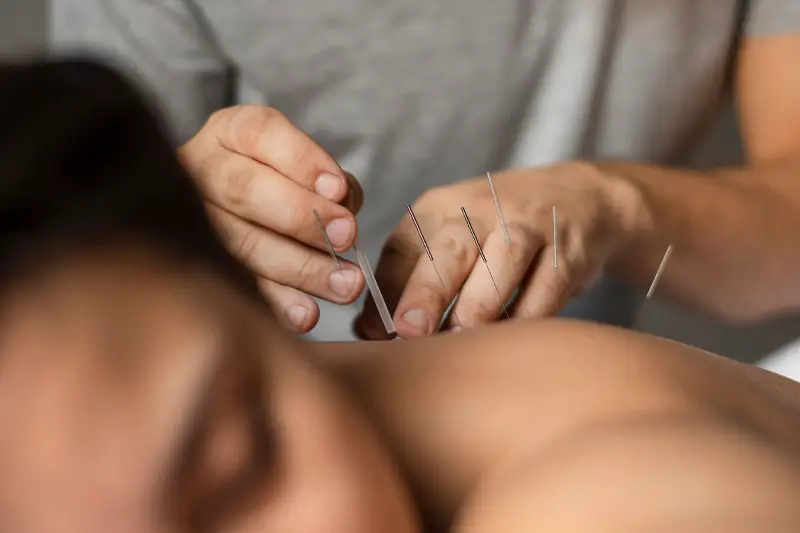 Dry Needling