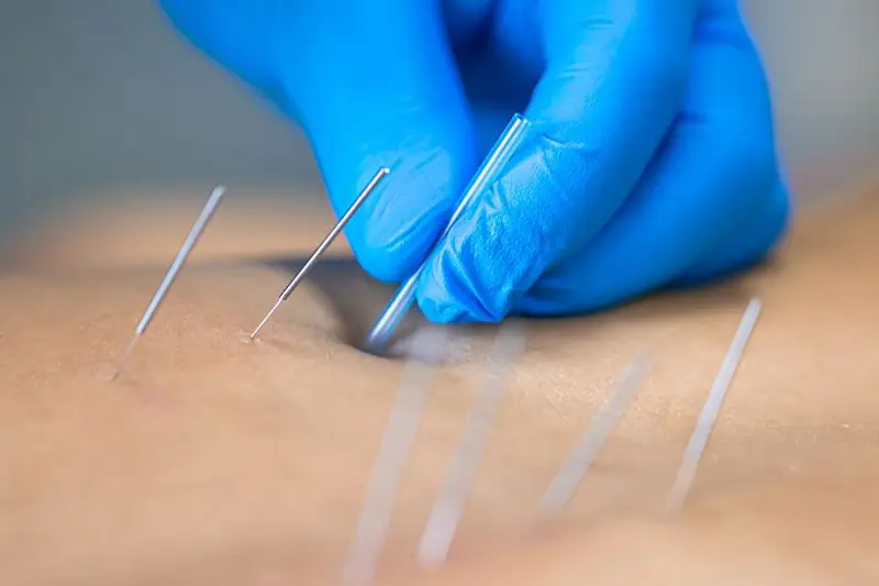 Dry Needling