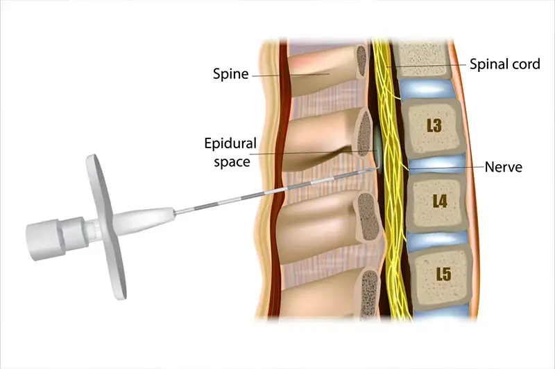 Epidural Injection