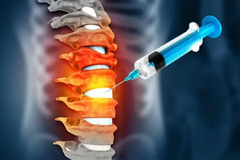 Epidural Injection