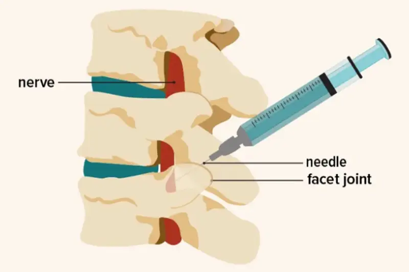 Facet Joint Injections
