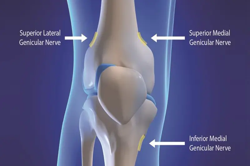Genicular Nerve Block