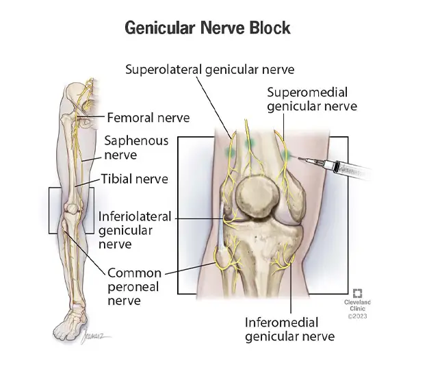Genicular Nerve Block
