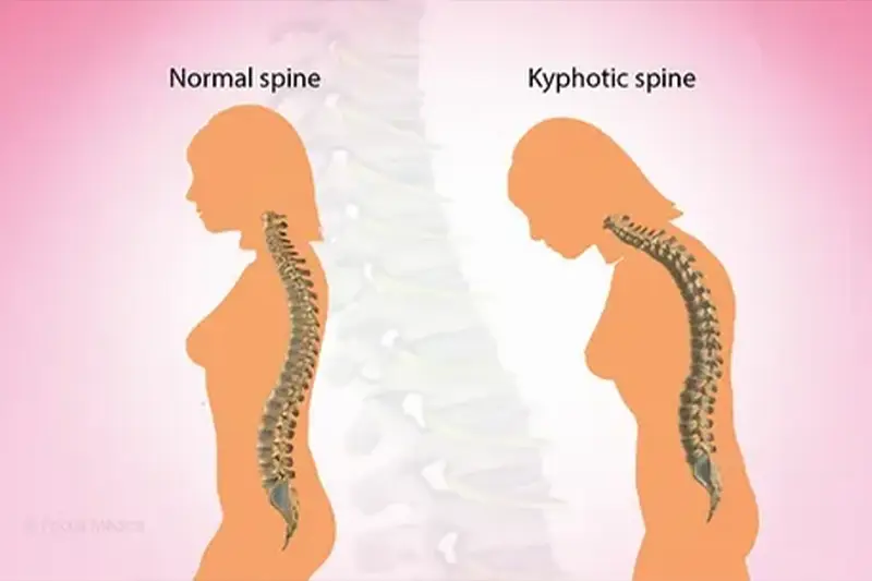 Kyphosis (Hunchback) Treatment