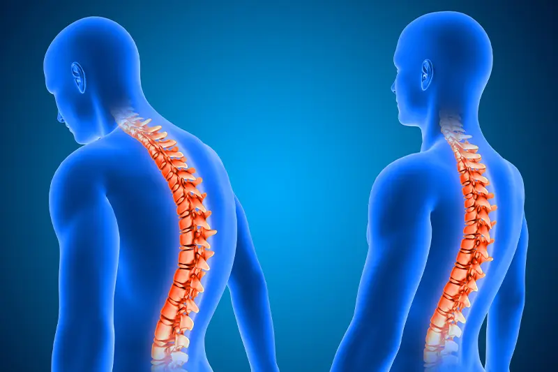 Kyphosis (Hunchback) Treatment